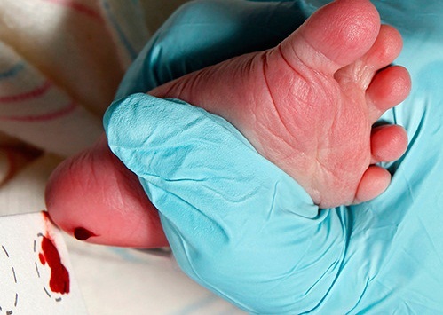 اجرای طرح غربالگری نوزادی در اهواز برای شناسایی بیماری متابولیک ارثی